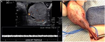 Case Report: Rare Presentation of Mixed Germ Cell Tumor in an Infant